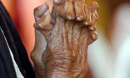 Diourbel La lèpre est toujours présente